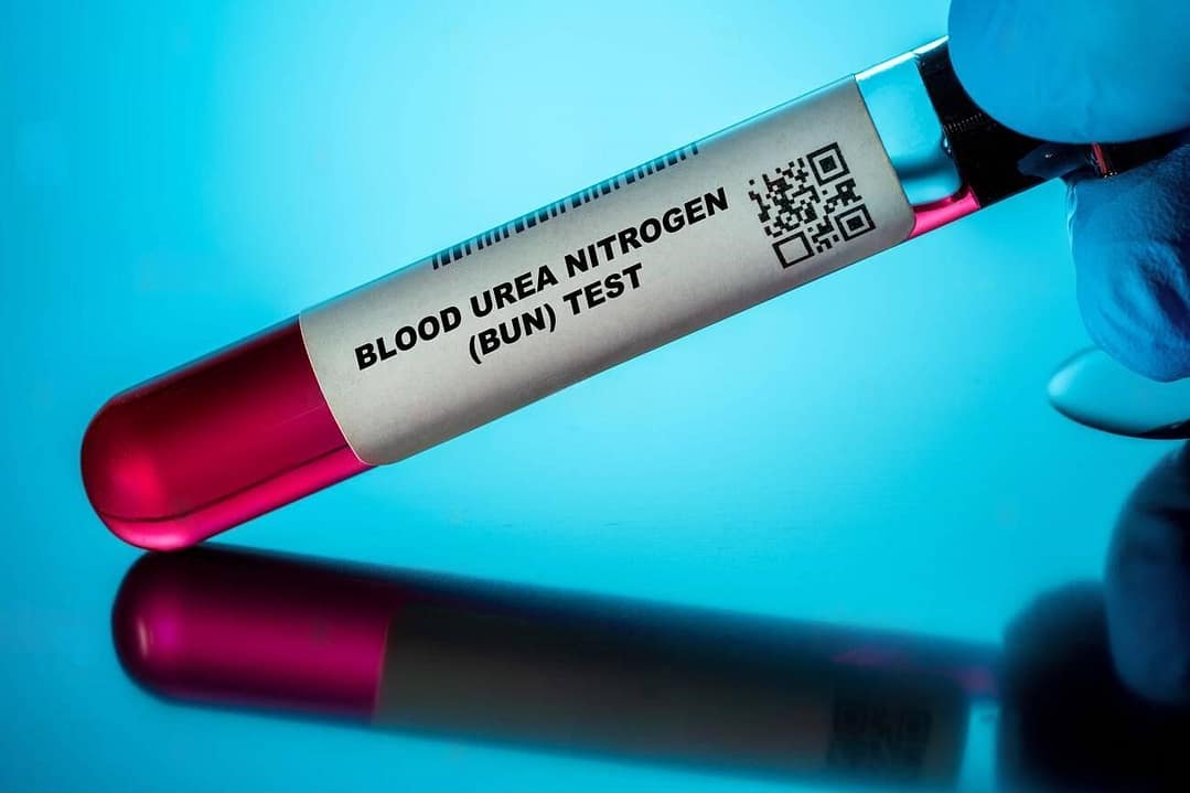 Read more about the article BUN (Blood Urea Nitrogen)