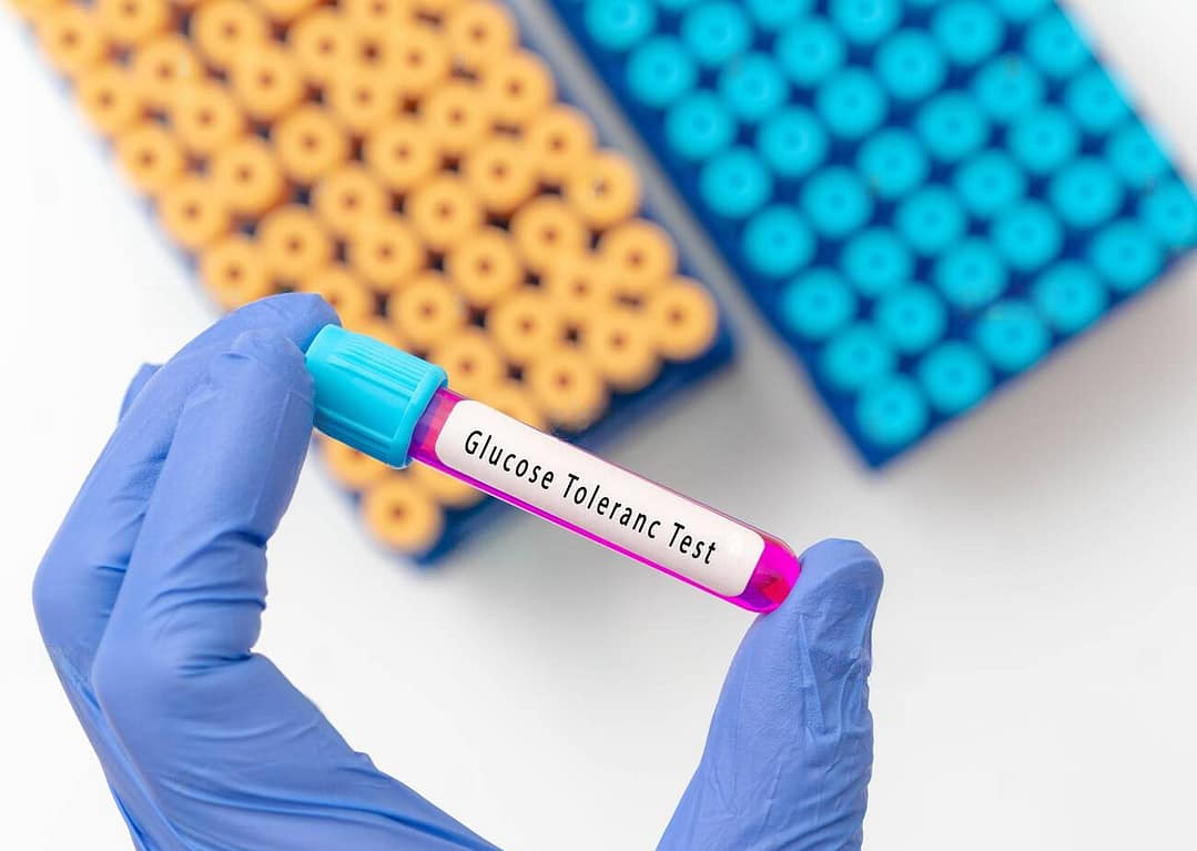 Read more about the article Oral Glucose Tolerance Test (OGTT) 50 grams