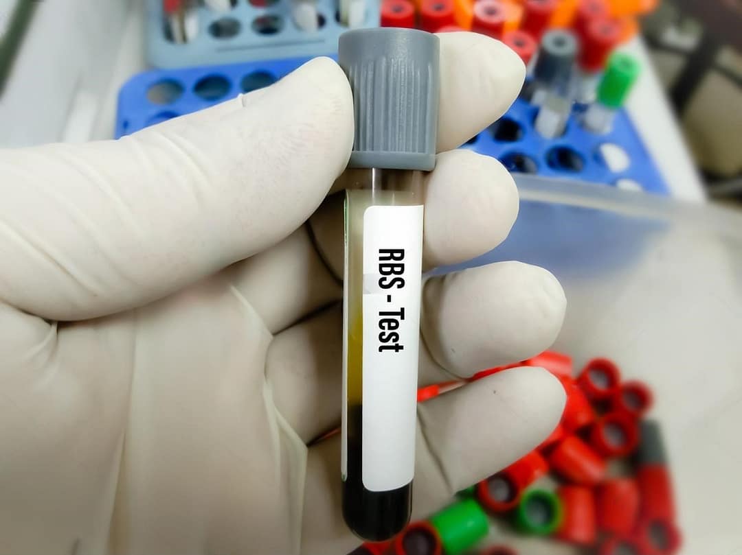 Read more about the article Random Blood Sugar (RBS / HGT)